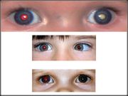 Cameras on Smartphone can spot eye cancer