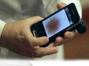 Simple Smartphone Device to catch skin cancer early