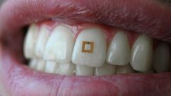Adios fitness bands, tooth-mounted sensors to track your health and diet
