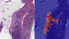 Google details its AI cancer detection study