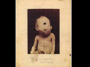 ವಿಚಿತ್ರ ರೋಗಗಳಿದ್ದರೂ ಬದುಕಿದ್ದ ಅಸಾಮಾನ್ಯ ವ್ಯಕ್ತಿಗಳು