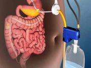 ವಿಜ್ಞಾನಿಗಳಿಂದ ಸ್ಥೂಲಾಕಾಯ ಸಮಸ್ಯೆಗೆ ಅದ್ಭುತ ಪರಿಹಾರ