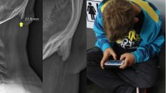 ಮೊಬೈಲ್ ಬಳಕೆಯಿಂದ ತಲೆಮೇಲೆ ಬೆಳೆಯುತ್ತಿದೆ ಕೊಂಬು!!