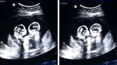 கருப்பையில் சண்டை போட்ட இரட்டை குழந்தைகள்- வைரல் வீடியோ.!