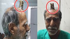 தலையில் 5' இன்ச் 'டெவில்ஸ் கொம்பு'டன் வாழும் ஷாம்! இவர் மனிதன் தானா?