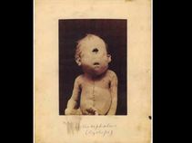 ವಿಚಿತ್ರ ರೋಗಗಳಿದ್ದರೂ ಬದುಕಿದ್ದ ಅಸಾಮಾನ್ಯ ವ್ಯಕ್ತಿಗಳು