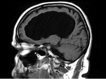 ಮೆದುಳು ಇಲ್ಲದೇ ಸಾಮಾನ್ಯರಂತೆ ಬದುಕುತ್ತಿರುವ ವ್ಯಕ್ತಿ