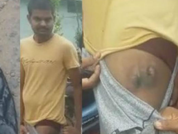 रेड्मी नोट 4 के फटने का सिलसिला जारी, जल गया युवक का पैर रेड्मी नोट 4 के फटने का सिलसिला जारी, जल गया युवक का पैर