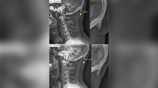 स्मार्टफोन का ज्यादा इस्तेमाल हो सकता है कारण: डॉ शाहर