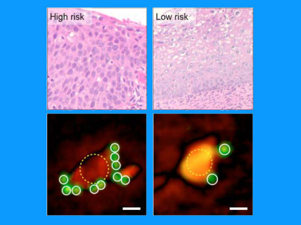 Smartphone Device can Spot Cancer Faster