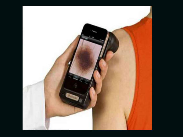 Simple Smartphone Device to catch skin cancer early