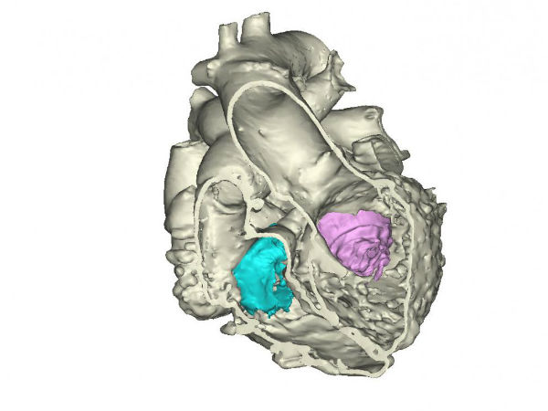 First 3D heart printed using multiple imaging techniques