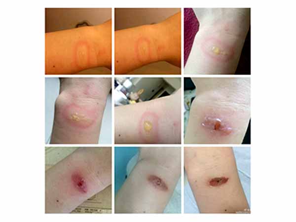 Xiaomi Mi Band 2 Burnt a User hand