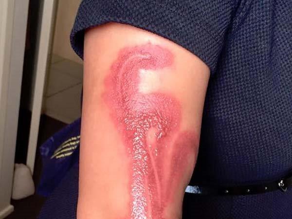 Apple iPhone 7 Causes Severe Second Degree Burns to a Sydney Woman