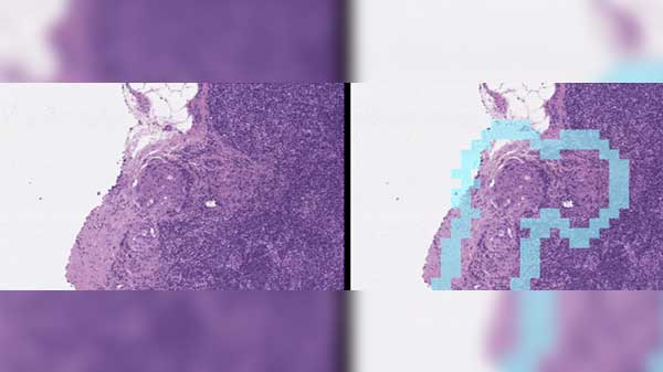 Google details its AI cancer detection study