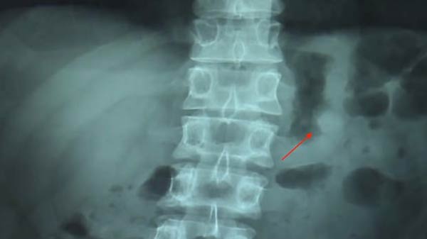 Apple Airpods found working perfectly in user's stomach