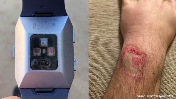 Smart Band Explodes On User's Wrist Leaving Third-Degree Burns