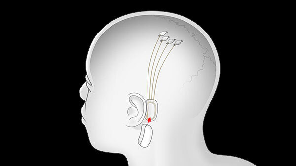 Questionable BCI Longevity