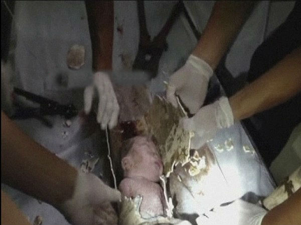  ಟಾಯ್ಲೆಟ್ ಪೈಪ್‌ನಲ್ಲಿ ಸಿಕ್ಕಿಬಿದ್ದ ಮಗುವನ್ನು ರಕ್ಷಣೆ ಮಾಡಿದ್ದು ಹೇಗೆ ?