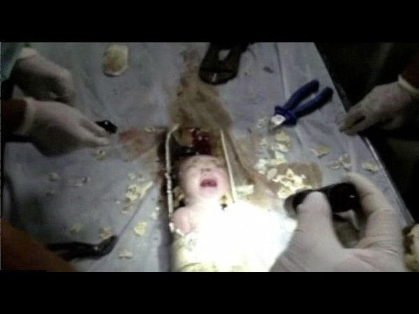  ಟಾಯ್ಲೆಟ್ ಪೈಪ್‌ನಲ್ಲಿ ಸಿಕ್ಕಿಬಿದ್ದ ಮಗುವನ್ನು ರಕ್ಷಣೆ ಮಾಡಿದ್ದು ಹೇಗೆ ?