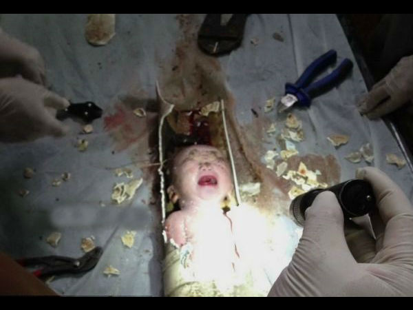  ಟಾಯ್ಲೆಟ್ ಪೈಪ್‌ನಲ್ಲಿ ಸಿಕ್ಕಿಬಿದ್ದ ಮಗುವನ್ನು ರಕ್ಷಣೆ ಮಾಡಿದ್ದು ಹೇಗೆ ?