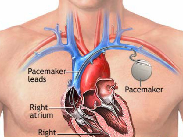 2 ಪೇಸ್ ಮೇಕರ್ಸ್