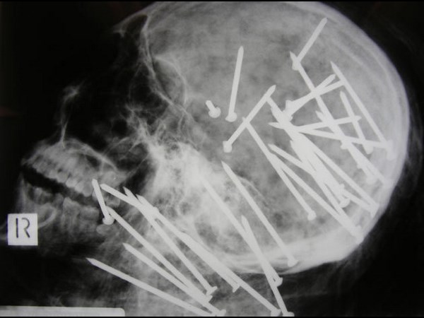 Worst x rays