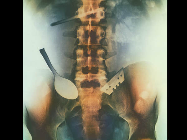 Worst x rays