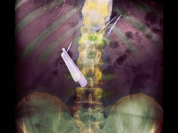Worst X rays