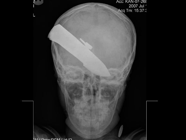 Worst Xrays
