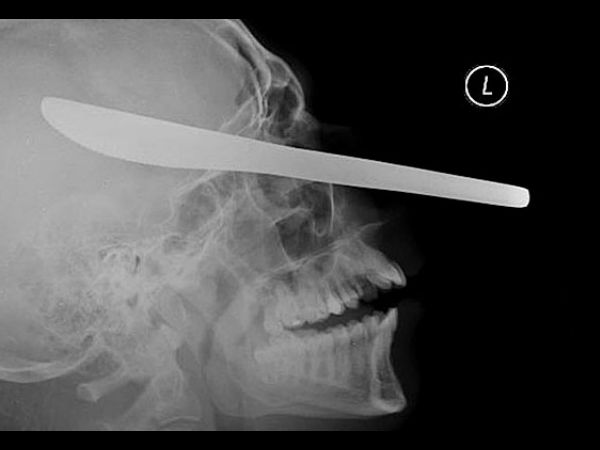 Worst Xrays