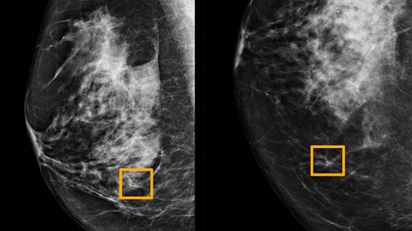 മാമോഗ്രാമിലെ 20% സ്തനാർബുദ തെളിവുകൾ