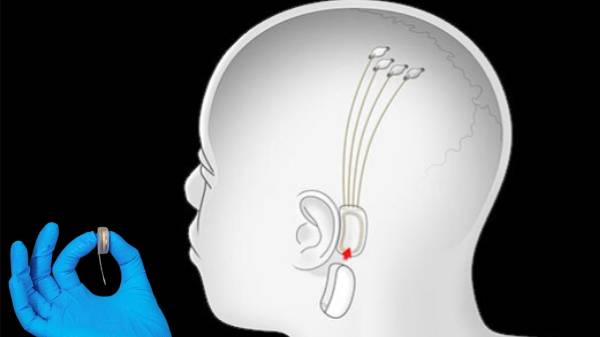 മനുഷ്യന്റെ തലച്ചോറിൽ കമ്പ്യൂട്ടർ ചിപ്പ് ഘടിപ്പിക്കാൻ മസ്കിന് അ‌നുമതി 