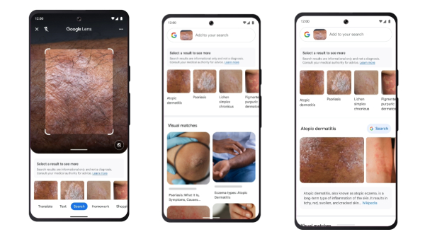ശരീരത്തിലെ പാടുകൾ തിരിച്ചറിയാൻ ഗൂഗിൾലെൻസ് സഹായിക്കുമെന്ന് ഗൂഗിൾ