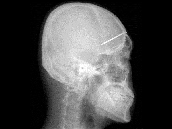 மருத்துவ உலகம் கண்டு வியந்த எக்ஸ் ரே படங்கள் 