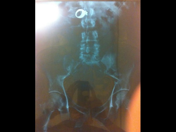 மருத்துவ உலகம் கண்டு வியந்த எக்ஸ் ரே படங்கள் 