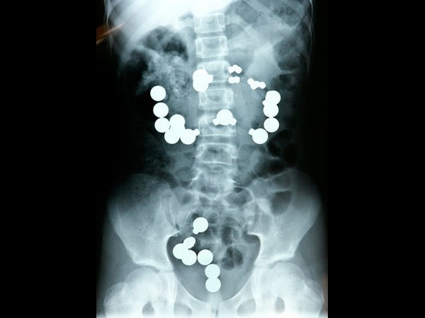 மருத்துவ உலகம் கண்டு வியந்த எக்ஸ் ரே படங்கள் 