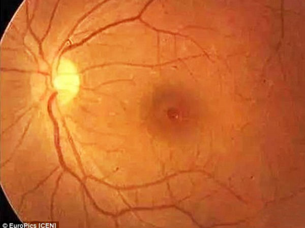 'ப்ளாஷ்' போட்டு போட்டோ; கண் பார்வையை இழந்த 3 மாத குழந்தை..!