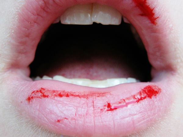 உதட்டை வெட்டிக்கொள்ள வேண்டும்