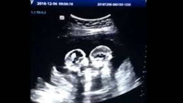  சண்டை போட்ட சிசு:  