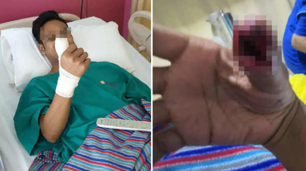 அவருடைய விரல் மற்றும் உள்ளங்கைகளில் பாதிப்பு ஏற்பட்டுள்ளது