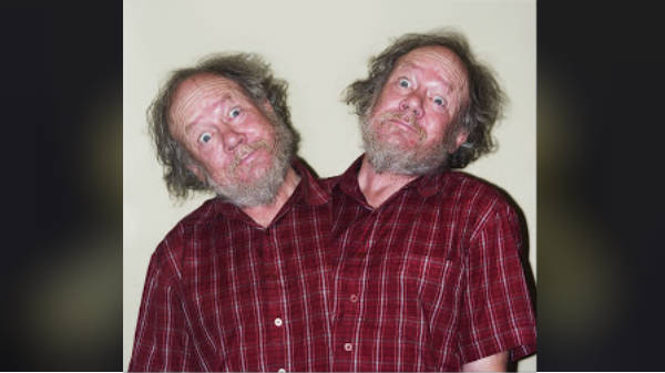 பைஸ்ஃபாலி (bicephaly) என்றால் என்ன? அறிவியல் உண்மை இதுதான் 