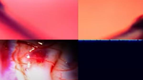 குரங்கின் மூளைக்குள் சிப்