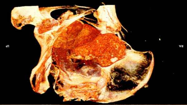 எக்ஸ்ரேவில் பதிவான குழந்தை மம்மியின் தடம்