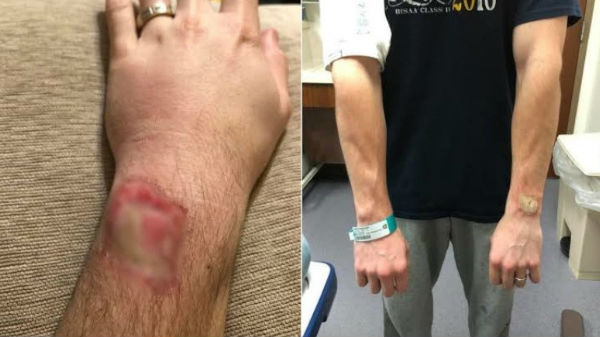 பேண்ட் உருகியது போல் உணர்ந்ததாக தகவல்