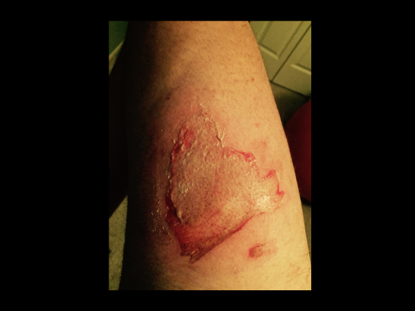 జేబులోనే కాలిపోయిన ఐఫోన్ 6! 