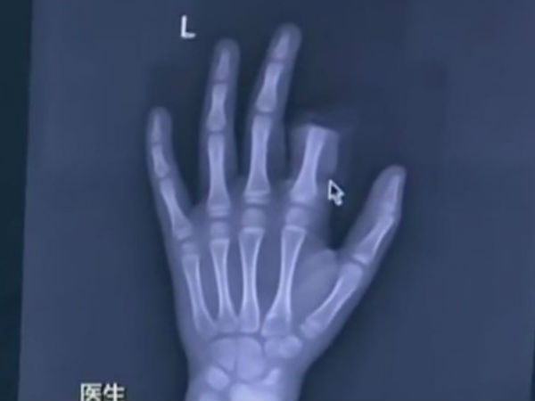 ఫోన్ వాడొద్దన్నారని, వేలు కత్తరించుకున్నాడు