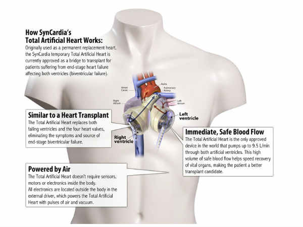 555 రోజులు తన గుండెను బ్యాగ్‌లో పెట్టుకు తిరిగాడు  