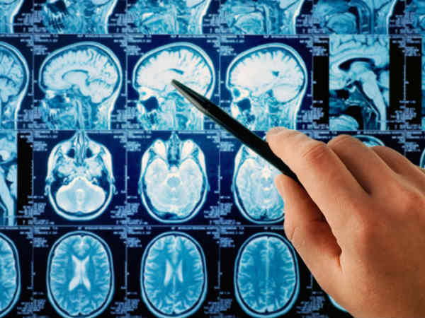 పదేళ్లలో బ్రెయిన్ ట్యూమర్