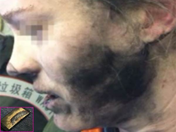 షాకింగ్.. చెవిలోనే పేలిపోయిన హెడ్‌ఫోన్